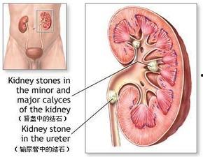 肾结石可以吃麻瓜吗吗,麻瓜的适宜性探讨