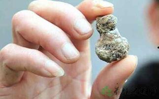 肾结石可以吃麻瓜吗吗,麻瓜的适宜性探讨