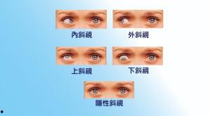 成人斜视导致近视吗视频,探究两者之间的关联