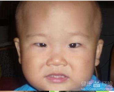 成人斜视导致近视吗视频,探究两者之间的关联