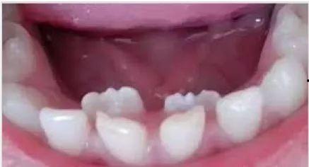 成人的下牙怎么修补视频,轻松掌握修复技巧