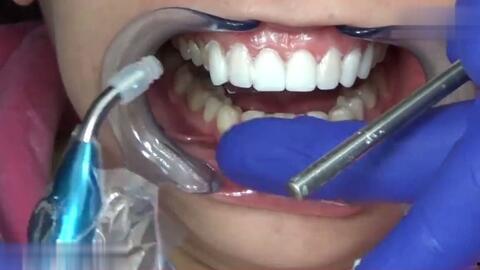 成人的下牙怎么修补视频,轻松掌握修复技巧