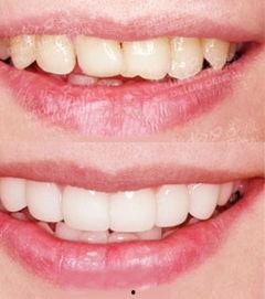 成人的下牙怎么修补视频,轻松掌握修复技巧