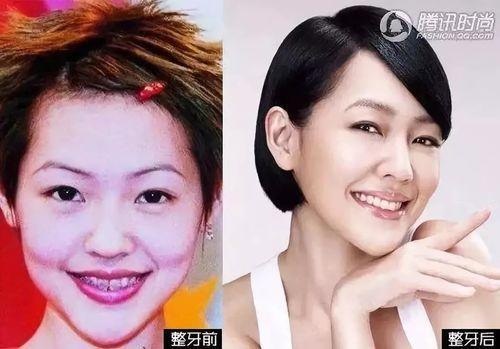 成人简单整牙教程视频大全