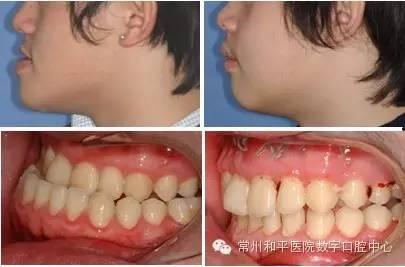 成人简单整牙教程视频大全