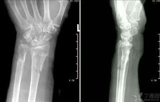 成人骨科手法视频,成人骨科手法治疗技巧解析与实操演示