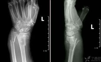 成人骨科手法视频,成人骨科手法治疗技巧解析与实操演示