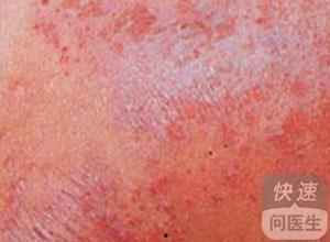 湿疹吃茭瓜好吗,湿疹患者适宜食用茭瓜吗？