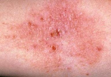 湿疹吃茭瓜好吗,湿疹患者适宜食用茭瓜吗？